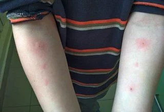 Самое время делать аллергопробы!